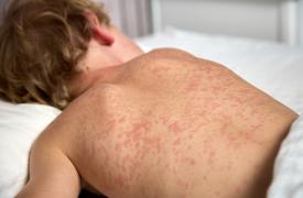 Το 2024 καταγράφηκαν 11 εκατ. κρούσματα ιλαράς - 800.000 περισσότερα από τα προπανδημικά χρόνια