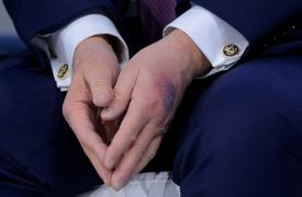 Νταβός: Με νέα μελανιά στο χέρι ο Ντόναλτ Τραμπ - Η εξήγηση που έδωσε