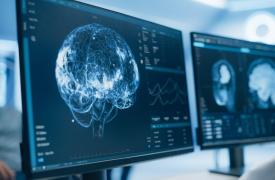 Έρευνα - ορόσημο φωτίζει την διαφορετική ανάπτυξη του εγκεφάλου στο σύνδρομο Down