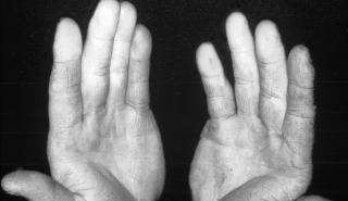 Οι ασθενείς με Σκληρόδερμα είναι πολλά περισσότερα από τη νόσο τους – Υποδιάγνωση στην Ελλάδα