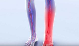 Θρόμβωση: Η καθημερινή συνήθεια που αυξάνει τον κίνδυνο – Τα συμπτώματα – «καμπανάκια»