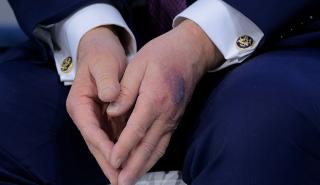 Νταβός: Με νέα μελανιά στο χέρι ο Ντόναλτ Τραμπ - Η εξήγηση που έδωσε