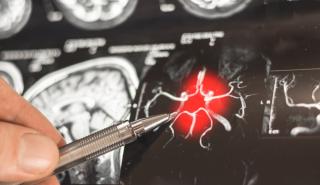 Η ατμοσφαιρική ρύπανση μπορεί να συμβάλει άμεσα στην εμφάνιση Αλτσχάιμερ