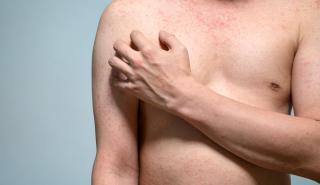 45 φορές αυξήθηκαν τα κρούσματα ιλαράς στην ΕΕ από το 2019 έως και το 2023