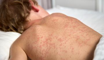 Το 2024 καταγράφηκαν 11 εκατ. κρούσματα ιλαράς - 800.000 περισσότερα από τα προπανδημικά χρόνια