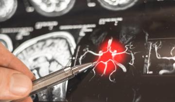 Η ατμοσφαιρική ρύπανση μπορεί να συμβάλει άμεσα στην εμφάνιση Αλτσχάιμερ