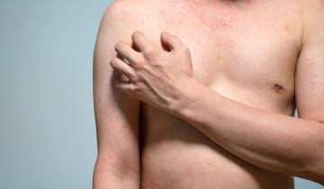 45 φορές αυξήθηκαν τα κρούσματα ιλαράς στην ΕΕ από το 2019 έως και το 2023