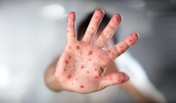 Οι ΗΠΑ αντιμέτωπες με τη σοβαρότερη επιδημία ιλαράς των τελευταίων 30 ετών