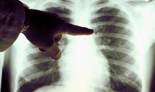 Καρκίνος του πνεύμονα: Σταθεροποιήθηκαν τα ποσοστά θνησιμότητας των γυναικών στην ΕΕ