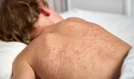 Το 2024 καταγράφηκαν 11 εκατ. κρούσματα ιλαράς - 800.000 περισσότερα από τα προπανδημικά χρόνια