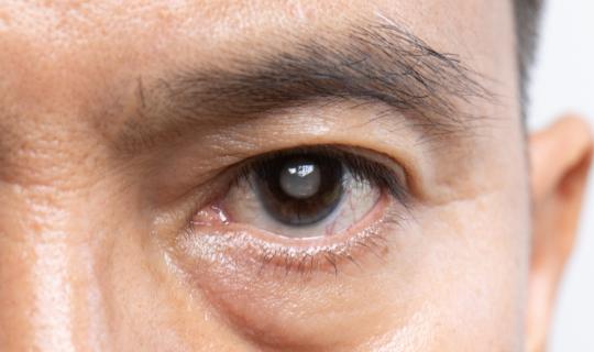 Έρευνα: Για κάθε ένα ασθενή με γλαύκωμα, υπάρχει άλλος ένας που δεν έχει διαγνωστεί