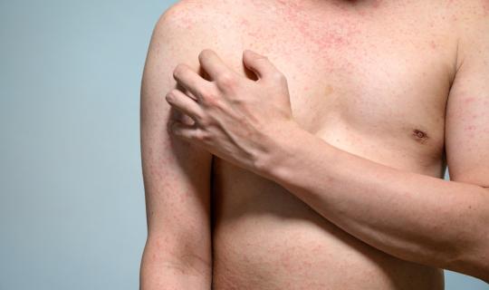 45 φορές αυξήθηκαν τα κρούσματα ιλαράς στην ΕΕ από το 2019 έως και το 2023