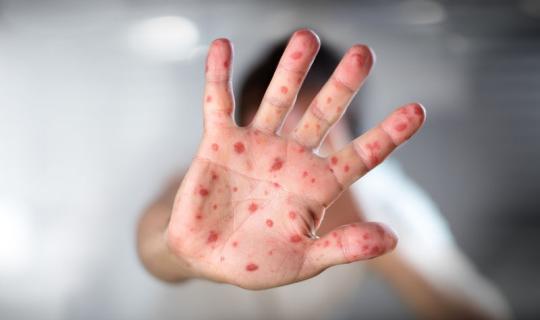 Οι ΗΠΑ αντιμέτωπες με τη σοβαρότερη επιδημία ιλαράς των τελευταίων 30 ετών