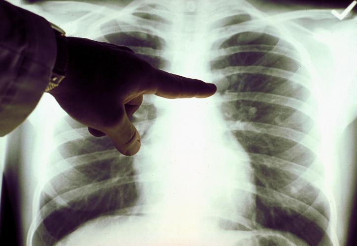 Καρκίνος πνεύμονα: Ο προσυμπτωματικός έλεγχος σώζει ζωές