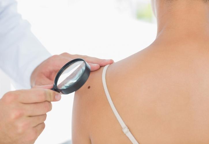 Μελάνωμα: Εγκρίθηκε θεραπεία για χορήγηση μετά το χειρουργείο