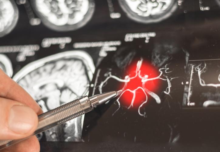 Η ατμοσφαιρική ρύπανση μπορεί να συμβάλει άμεσα στην εμφάνιση Αλτσχάιμερ