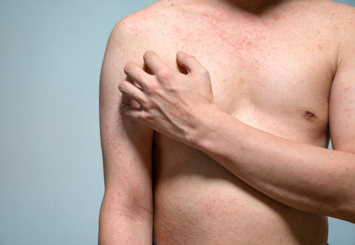 45 φορές αυξήθηκαν τα κρούσματα ιλαράς στην ΕΕ από το 2019 έως και το 2023