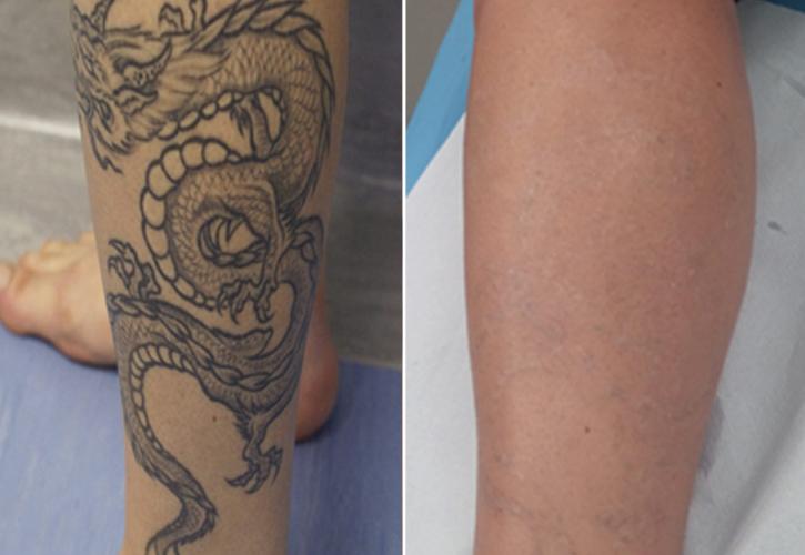 Στην Ελλάδα το πρώτο laser που σβήνει τελείως τα τατουάζ